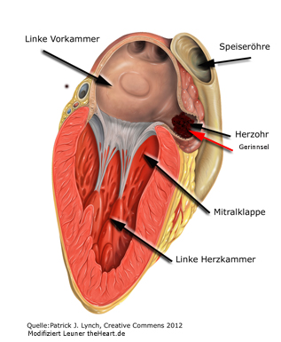 Thrombus linkes Herzohr
